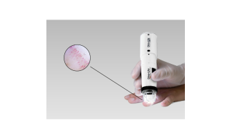 Video Capilariscop - instrument indispensabil in reumatologie Video Capilariscop - instrument indispensabil in reumatologie