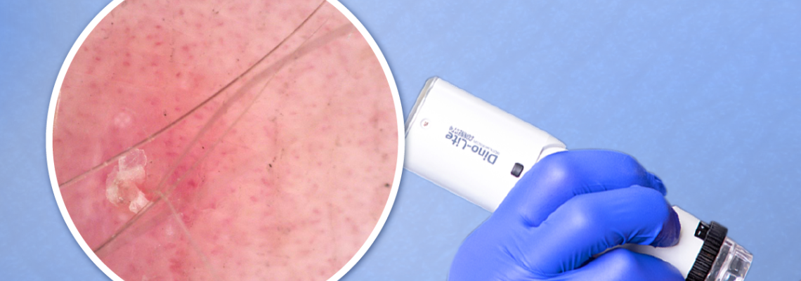 Dermatoscopul si importanta acestui microscop digital in evaluarea dermatologica Dermatoscopul si importanta acestui microscop digital in evaluarea dermatologica