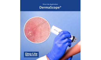 Dermatoscopul si importanta acestui microscop digital in evaluarea dermatologica