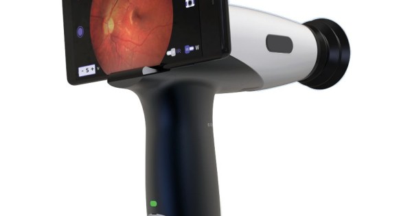 Retinascope - camera digitala screening retinoscopie